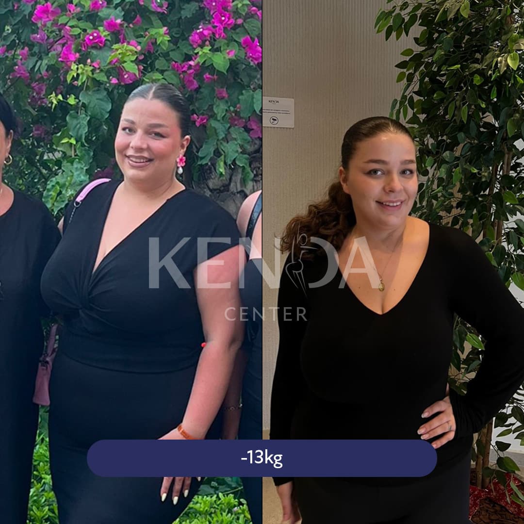 Kenda before-and-after result 5