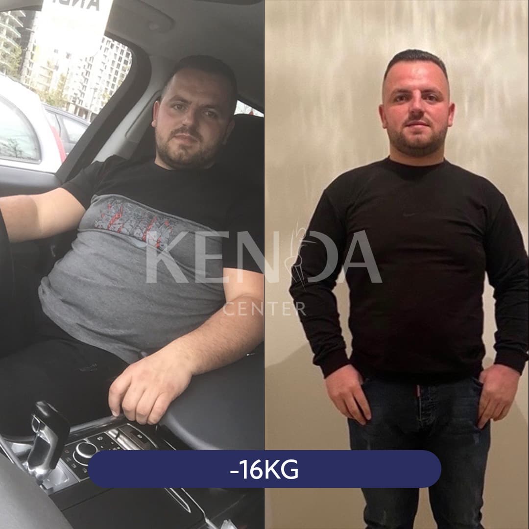 Kenda before-and-after result 5